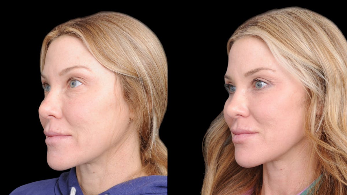 Upper & Lower Eyelid Surgery Before & After Gallery - Patient 169152 - Image 3