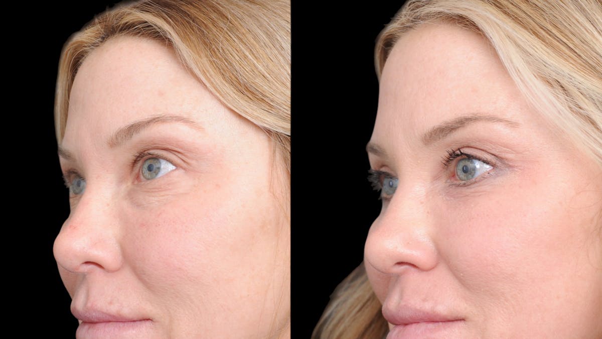 Upper & Lower Eyelid Surgery Before & After Gallery - Patient 169152 - Image 4