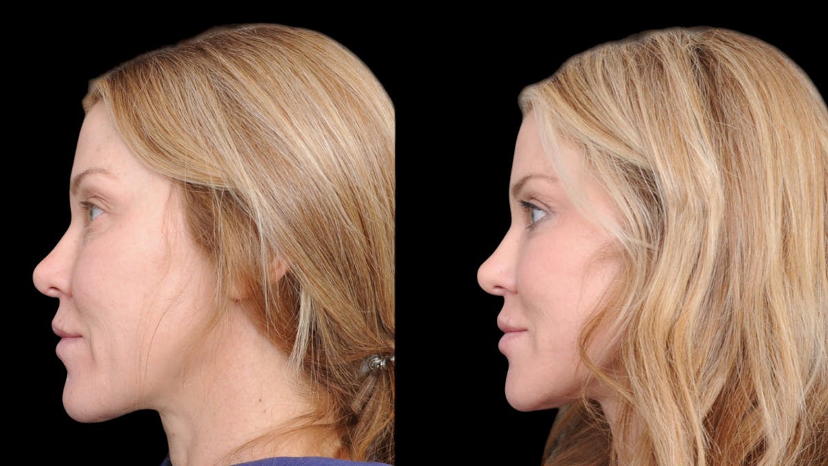 Upper & Lower Eyelid Surgery Before & After Gallery - Patient 169152 - Image 5