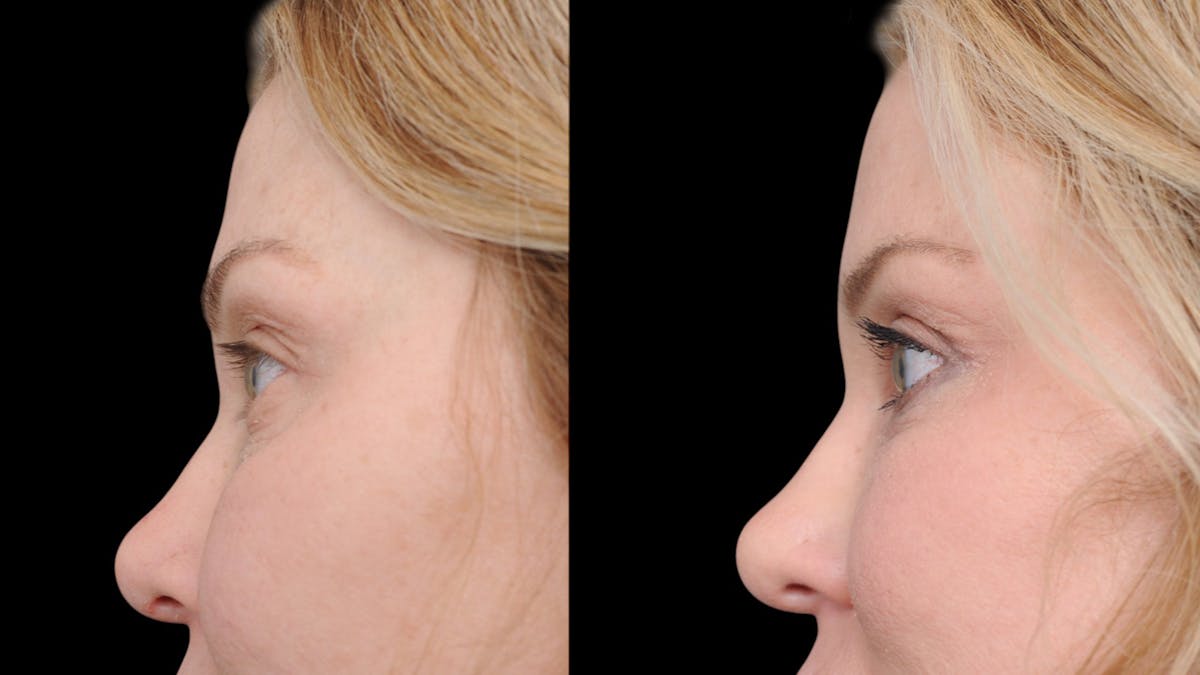 Upper & Lower Eyelid Surgery Before & After Gallery - Patient 169152 - Image 6