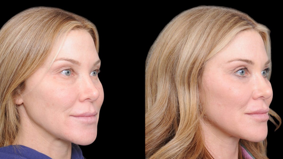 Upper & Lower Eyelid Surgery Before & After Gallery - Patient 169152 - Image 7