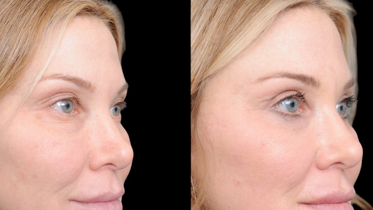 Upper & Lower Eyelid Surgery Before & After Gallery - Patient 169152 - Image 8