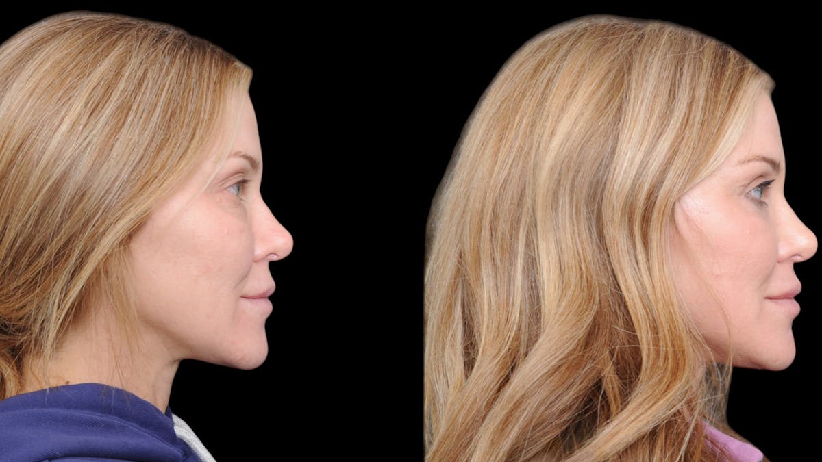Upper & Lower Eyelid Surgery Before & After Gallery - Patient 169152 - Image 9