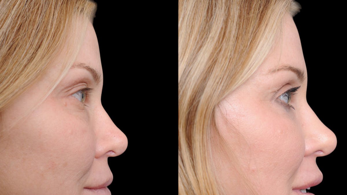 Upper & Lower Eyelid Surgery Before & After Gallery - Patient 169152 - Image 10