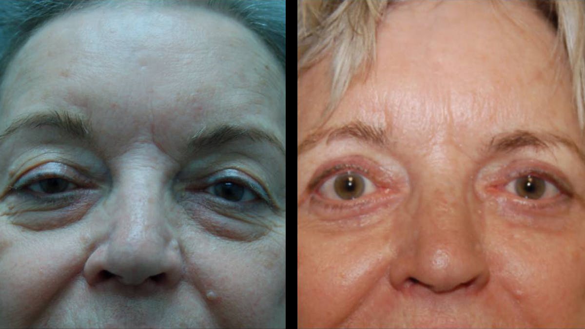 Upper & Lower Eyelid Surgery Before & After Gallery - Patient 375744 - Image 1