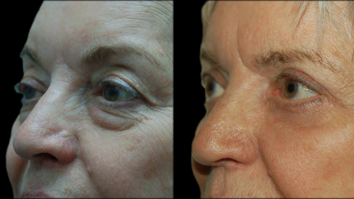 Upper & Lower Eyelid Surgery Before & After Gallery - Patient 375744 - Image 2