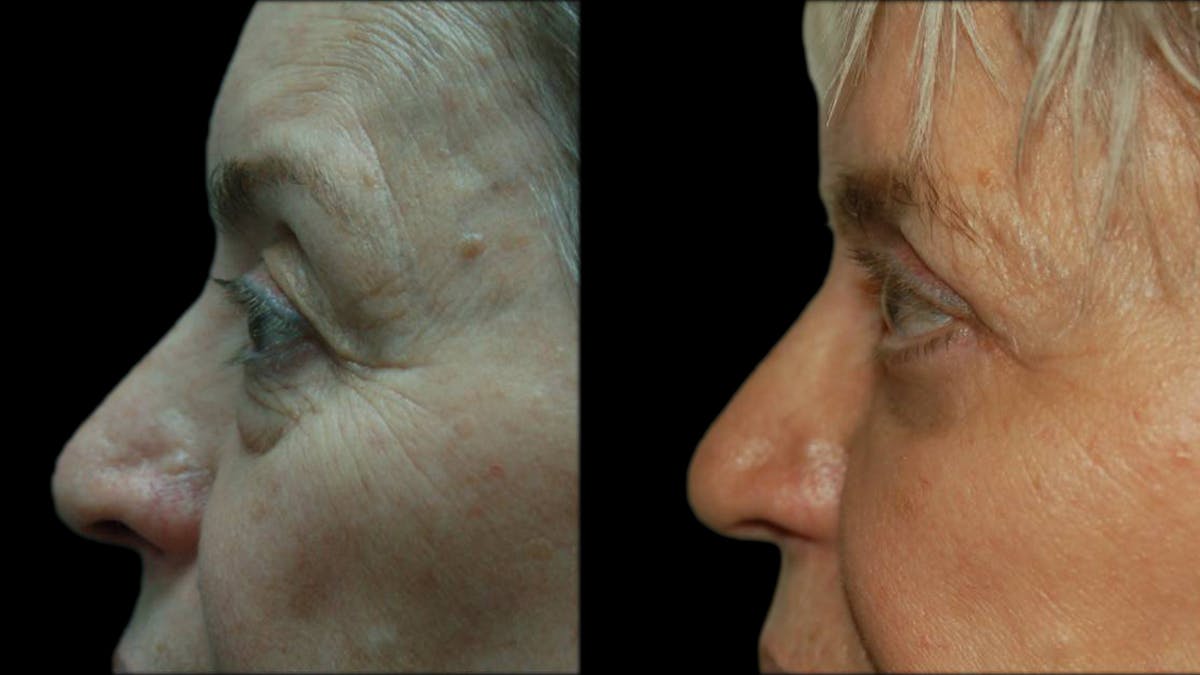 Upper & Lower Eyelid Surgery Before & After Gallery - Patient 375744 - Image 3