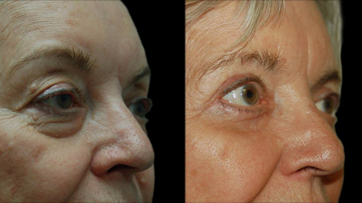 Upper & Lower Eyelid Surgery Before & After Gallery - Patient 375744 - Image 4
