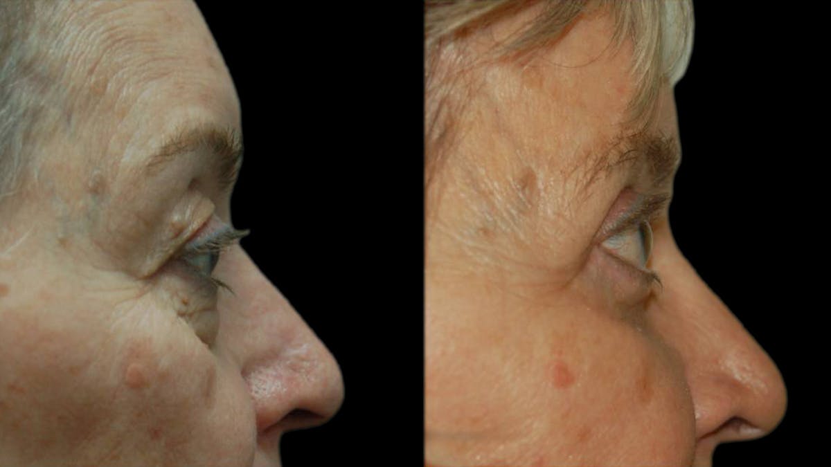 Upper & Lower Eyelid Surgery Before & After Gallery - Patient 375744 - Image 5
