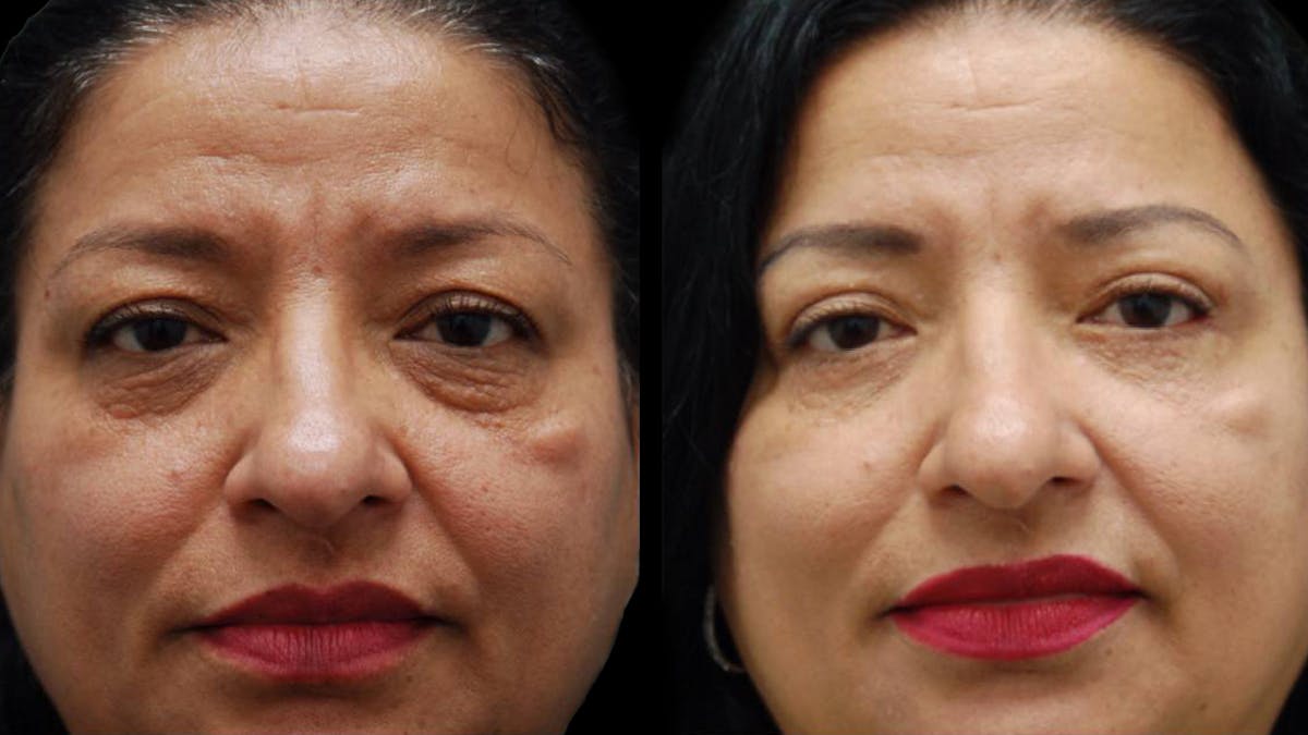 Upper & Lower Eyelid Surgery Before & After Gallery - Patient 210198 - Image 1