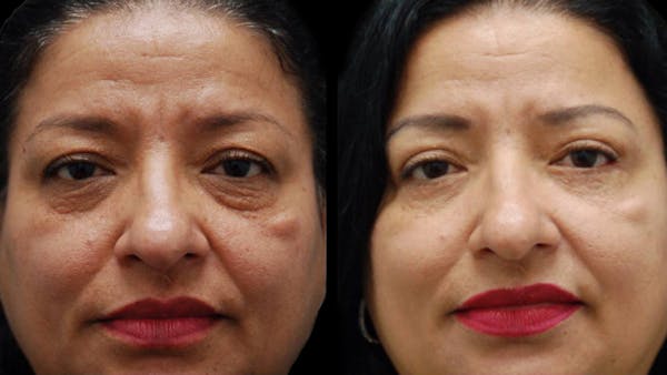 Upper & Lower Eyelid Surgery Before & After Gallery - Patient 210198 - Image 1
