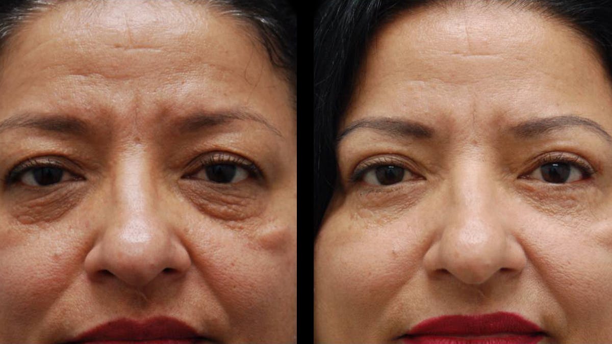 Upper & Lower Eyelid Surgery Before & After Gallery - Patient 210198 - Image 2