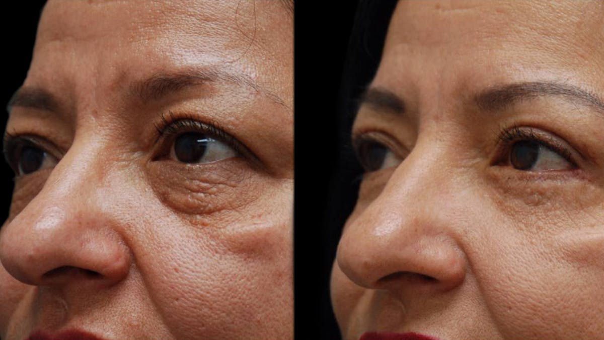 Upper & Lower Eyelid Surgery Before & After Gallery - Patient 210198 - Image 3