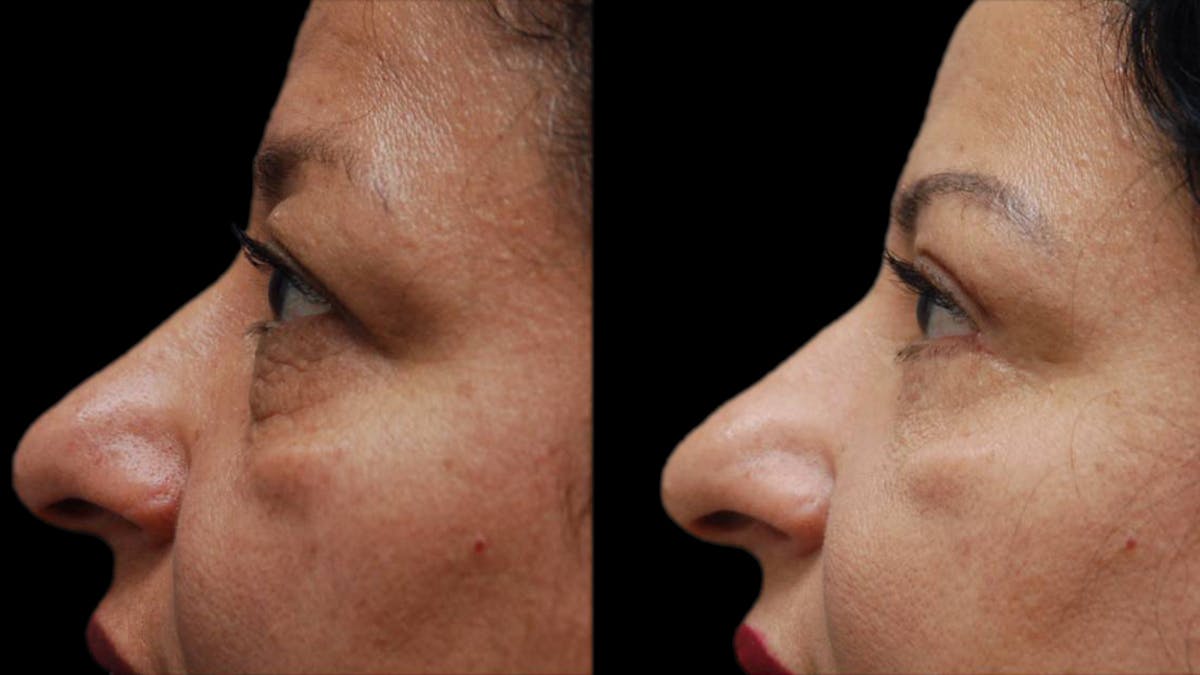 Upper & Lower Eyelid Surgery Before & After Gallery - Patient 210198 - Image 4