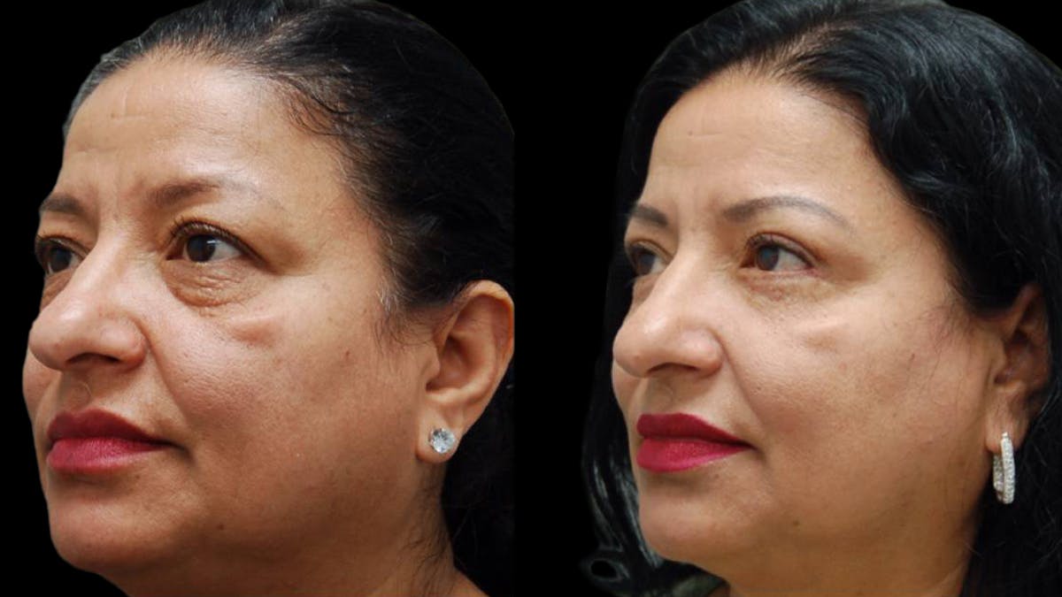 Upper & Lower Eyelid Surgery Before & After Gallery - Patient 210198 - Image 5