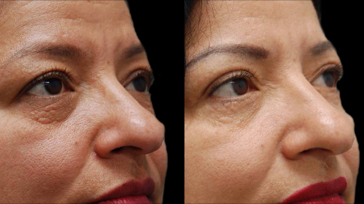 Upper & Lower Eyelid Surgery Before & After Gallery - Patient 210198 - Image 6