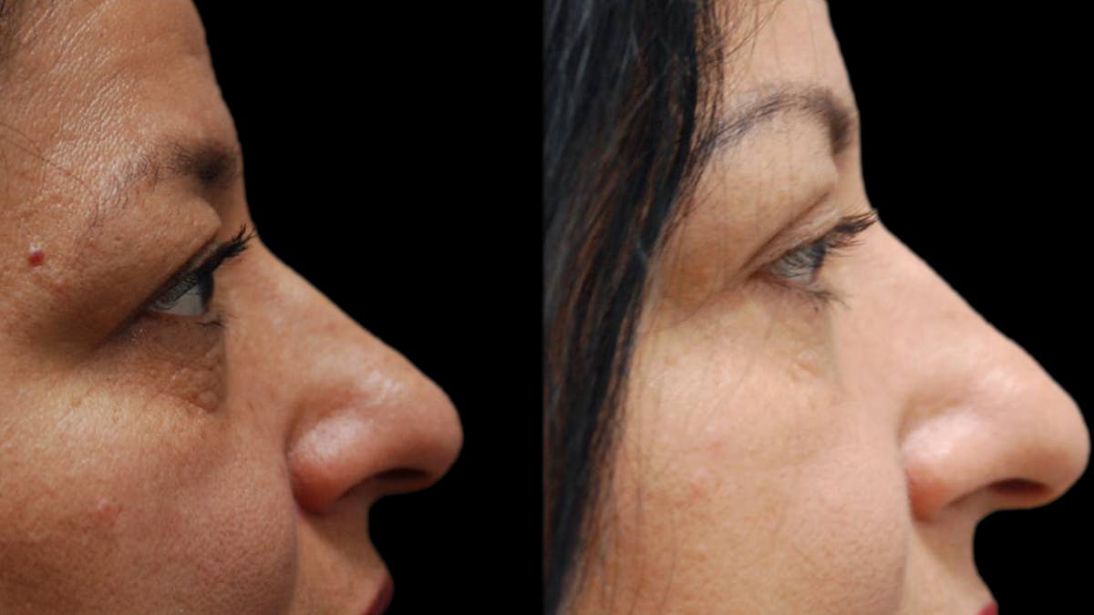 Upper & Lower Eyelid Surgery Before & After Gallery - Patient 210198 - Image 7