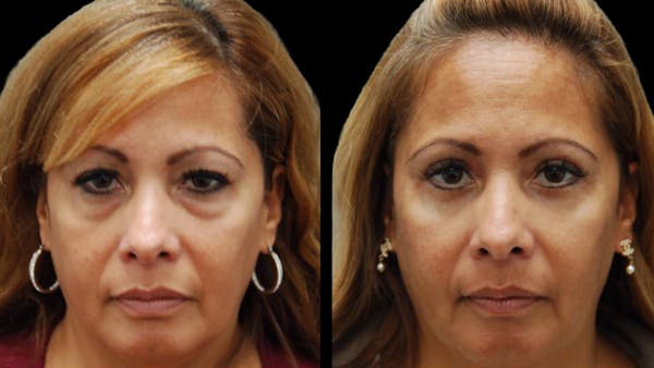 Upper & Lower Eyelid Surgery Before & After Gallery - Patient 109023 - Image 1