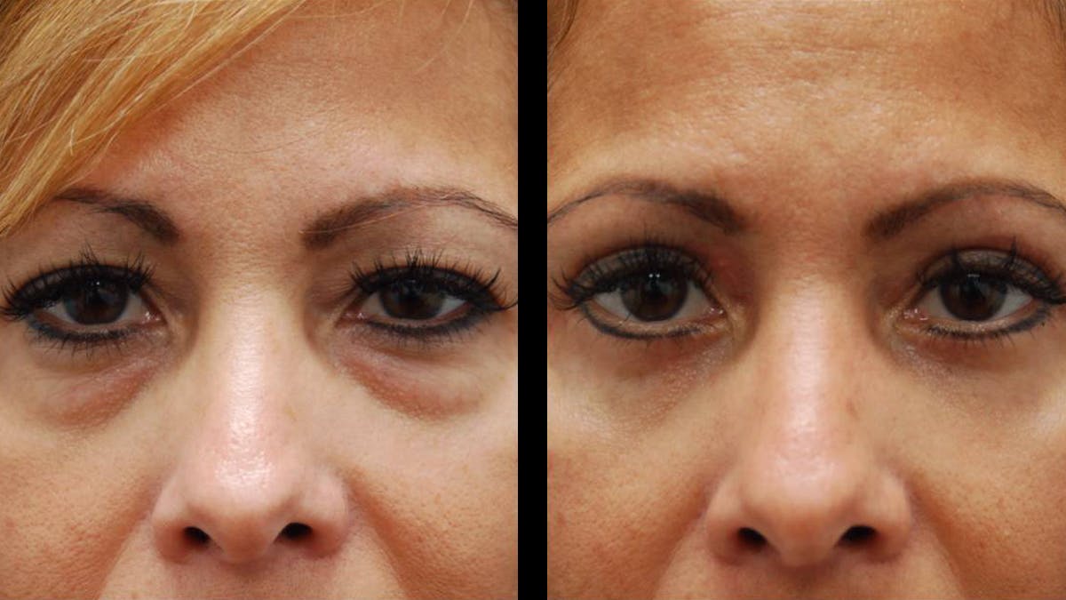 Upper & Lower Eyelid Surgery Before & After Gallery - Patient 109023 - Image 2