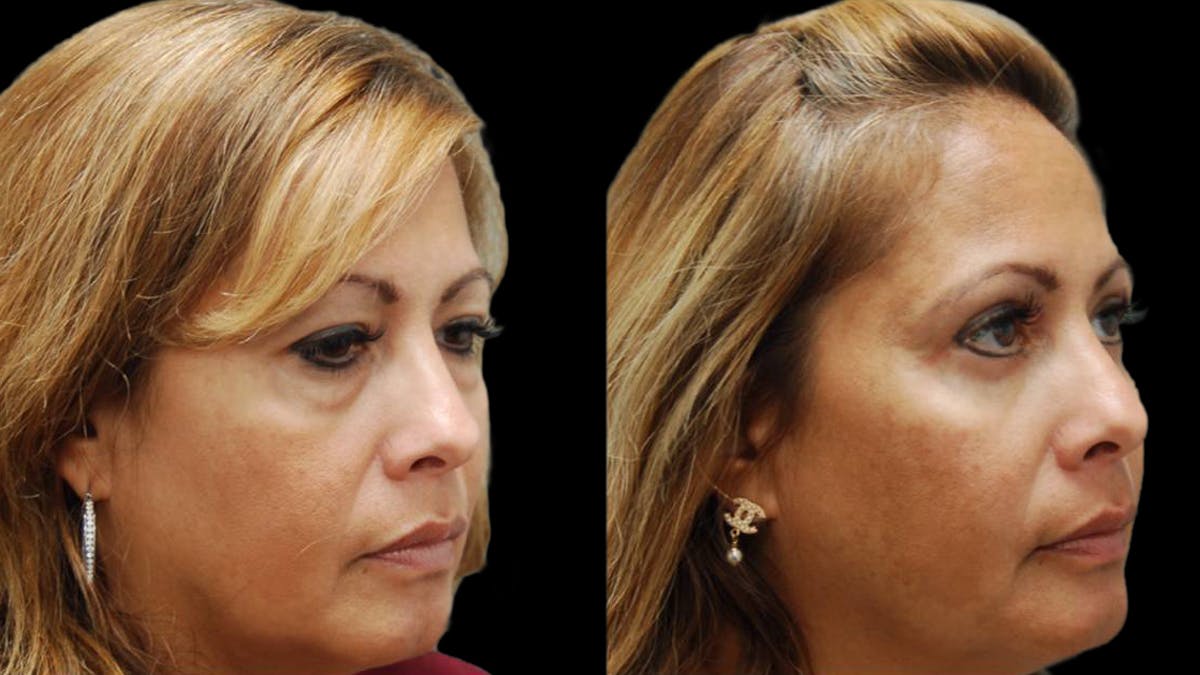 Upper & Lower Eyelid Surgery Before & After Gallery - Patient 109023 - Image 3