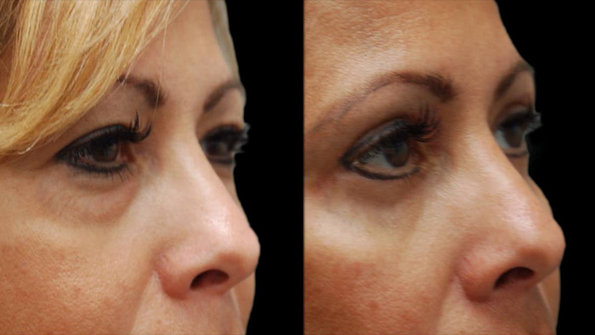 Upper & Lower Eyelid Surgery Before & After Gallery - Patient 109023 - Image 4