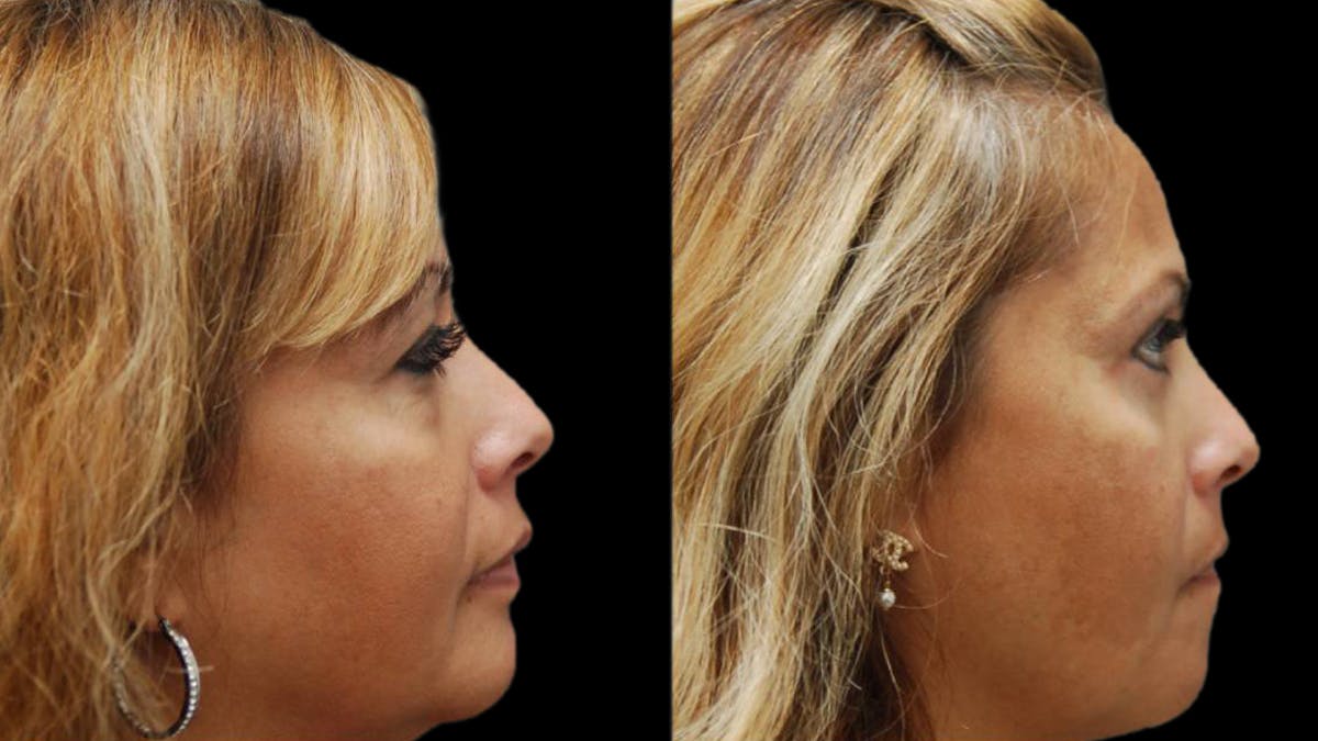 Upper & Lower Eyelid Surgery Before & After Gallery - Patient 109023 - Image 5