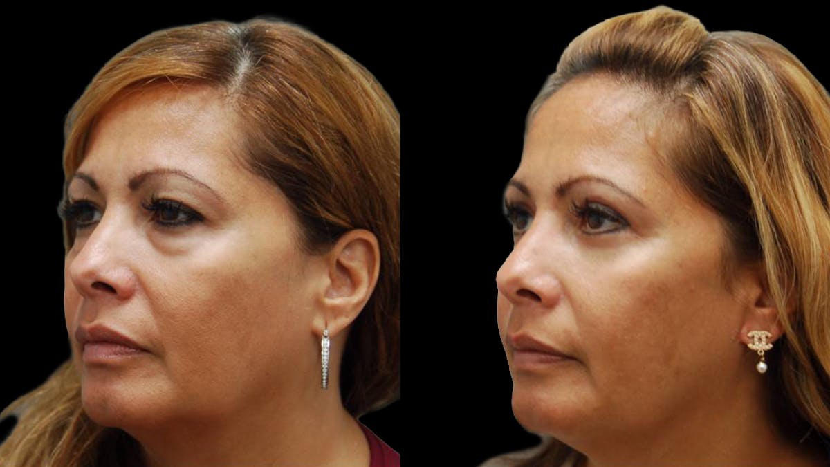 Upper & Lower Eyelid Surgery Before & After Gallery - Patient 109023 - Image 6