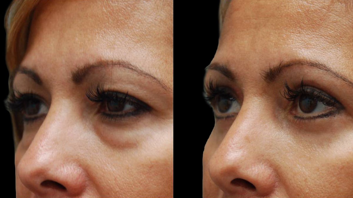 Upper & Lower Eyelid Surgery Before & After Gallery - Patient 109023 - Image 7