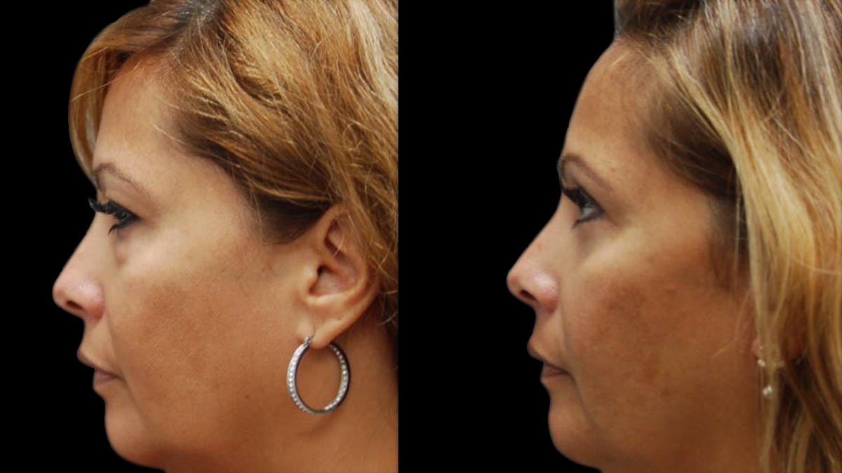 Upper & Lower Eyelid Surgery Before & After Gallery - Patient 109023 - Image 8