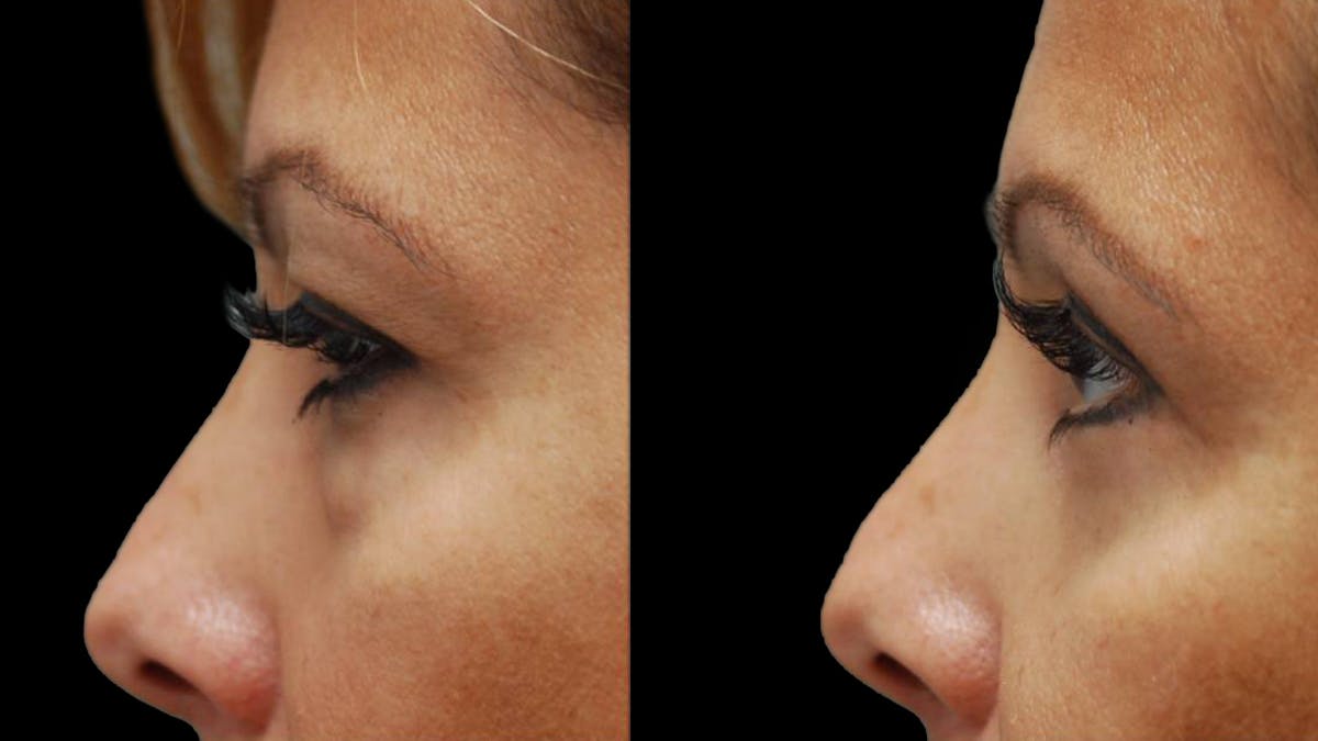 Upper & Lower Eyelid Surgery Before & After Gallery - Patient 109023 - Image 9