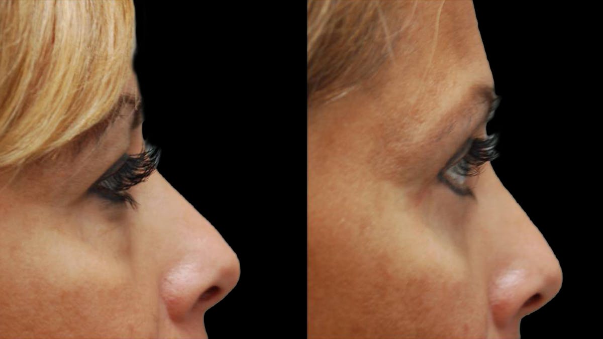 Upper & Lower Eyelid Surgery Before & After Gallery - Patient 109023 - Image 10