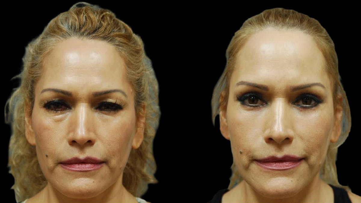 Upper & Lower Eyelid Surgery Before & After Gallery - Patient 288788 - Image 1