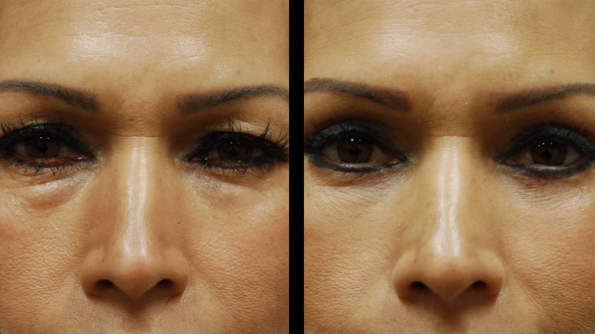 Upper & Lower Eyelid Surgery Before & After Gallery - Patient 288788 - Image 2