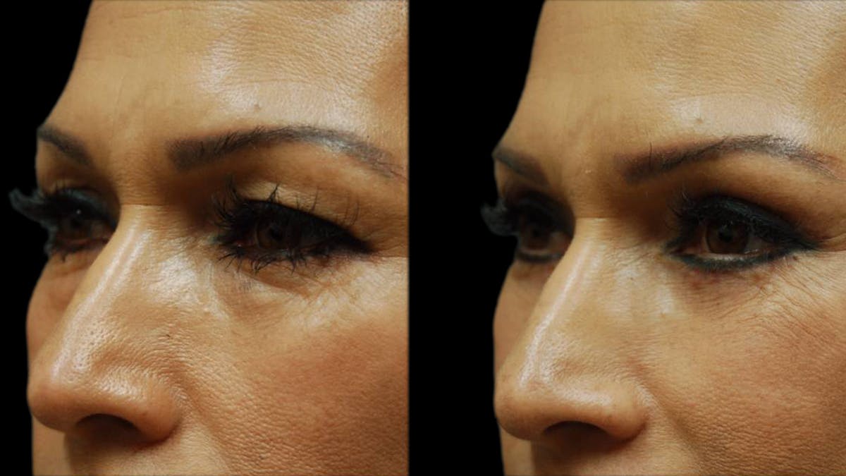 Upper & Lower Eyelid Surgery Before & After Gallery - Patient 288788 - Image 3