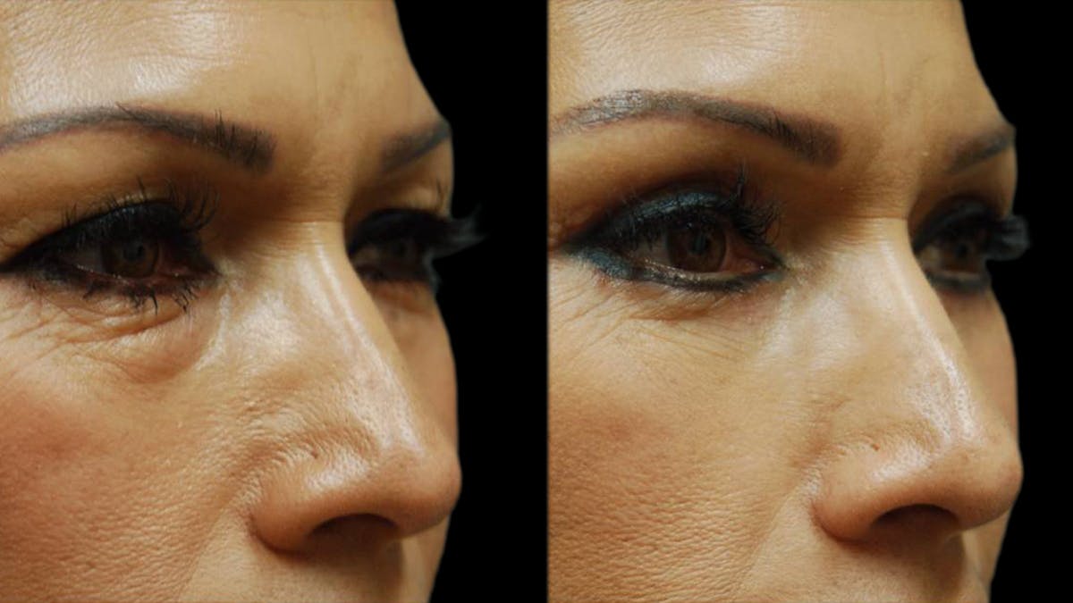 Upper & Lower Eyelid Surgery Before & After Gallery - Patient 288788 - Image 4