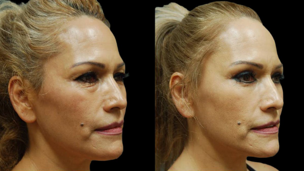 Upper & Lower Eyelid Surgery Before & After Gallery - Patient 288788 - Image 5
