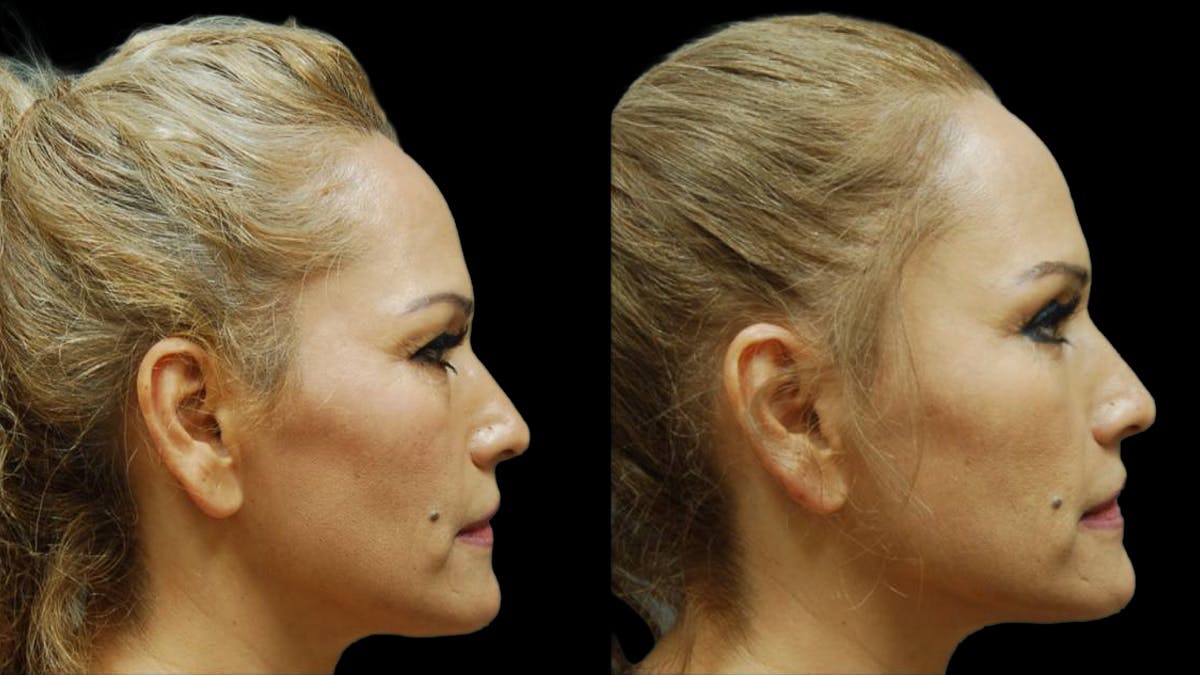 Upper & Lower Eyelid Surgery Before & After Gallery - Patient 288788 - Image 6