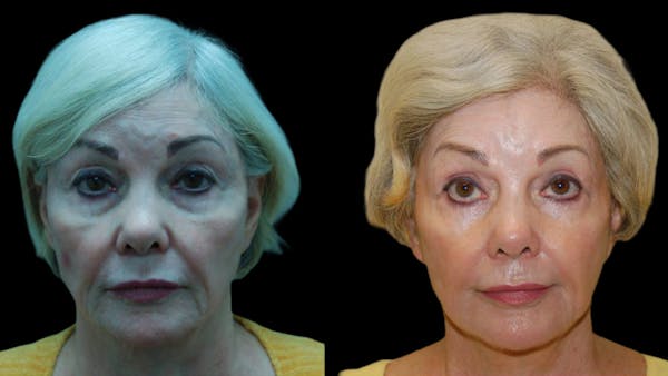 Upper & Lower Eyelid Surgery Before & After Gallery - Patient 376394 - Image 1