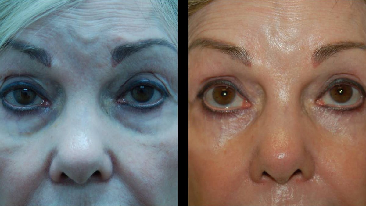 Upper & Lower Eyelid Surgery Before & After Gallery - Patient 376394 - Image 2