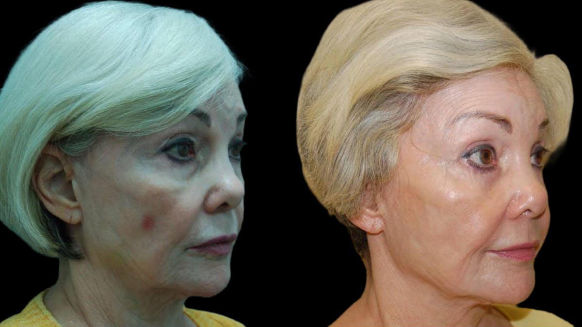 Upper & Lower Eyelid Surgery Before & After Gallery - Patient 376394 - Image 3