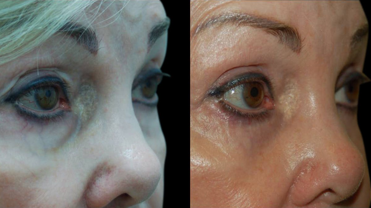 Upper & Lower Eyelid Surgery Before & After Gallery - Patient 376394 - Image 4