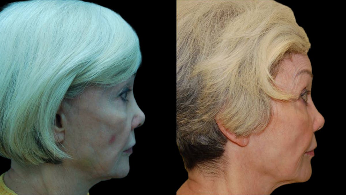 Upper & Lower Eyelid Surgery Before & After Gallery - Patient 376394 - Image 5