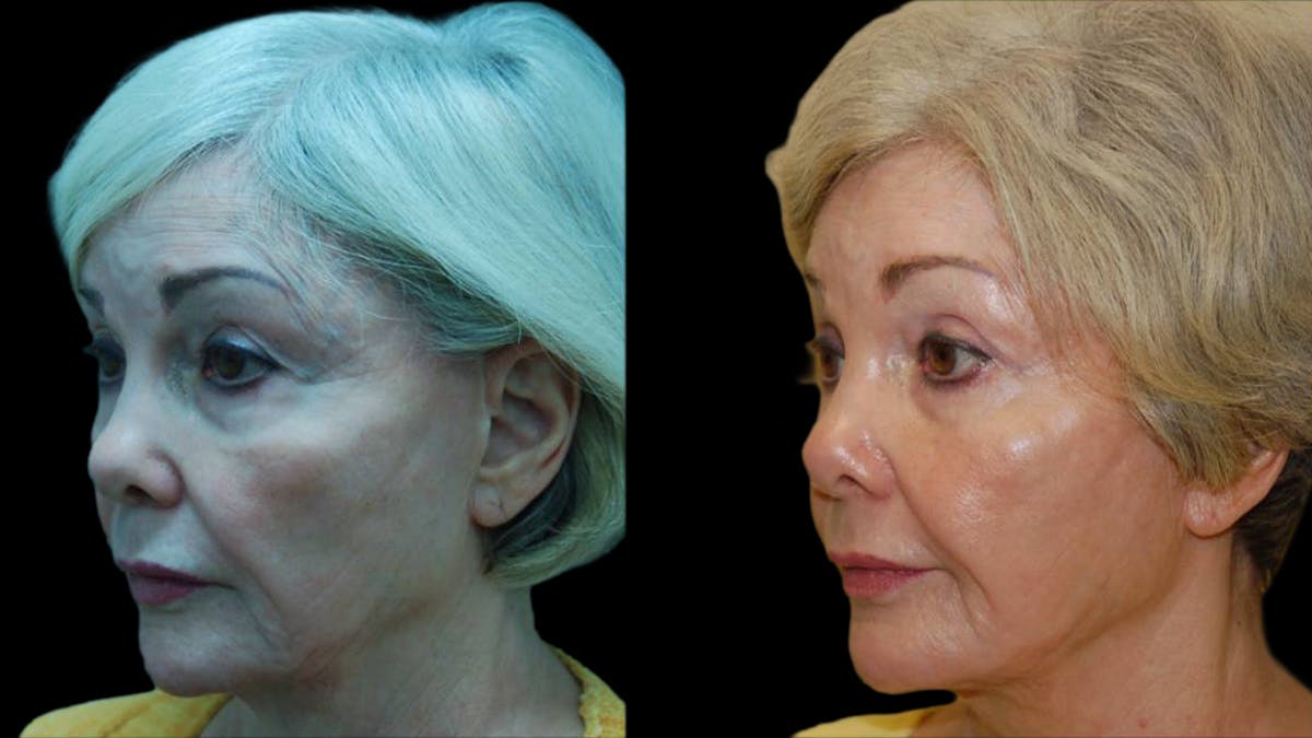 Upper & Lower Eyelid Surgery Before & After Gallery - Patient 376394 - Image 6