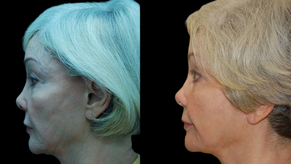 Upper & Lower Eyelid Surgery Before & After Gallery - Patient 376394 - Image 8