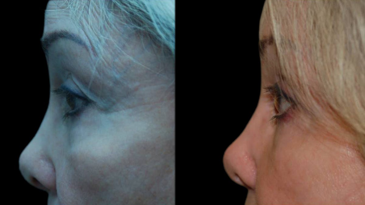 Upper & Lower Eyelid Surgery Before & After Gallery - Patient 376394 - Image 9