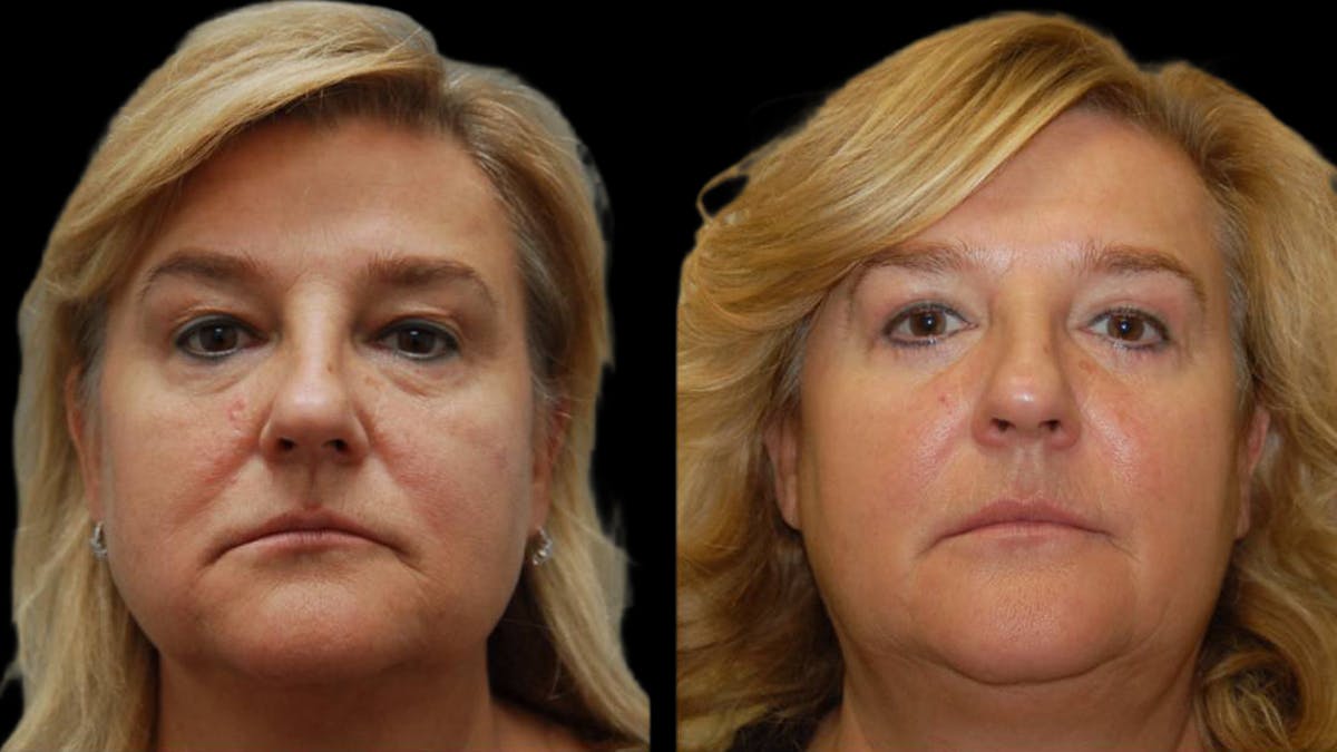 Upper & Lower Eyelid Surgery Before & After Gallery - Patient 246596 - Image 1