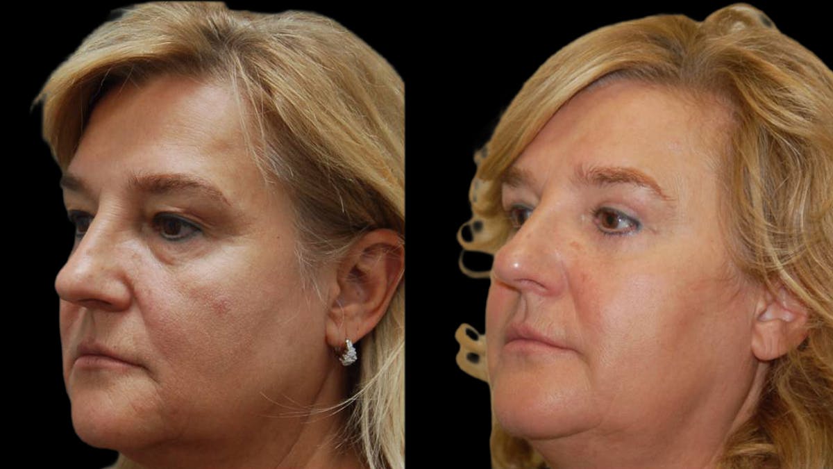 Upper & Lower Eyelid Surgery Before & After Gallery - Patient 246596 - Image 3