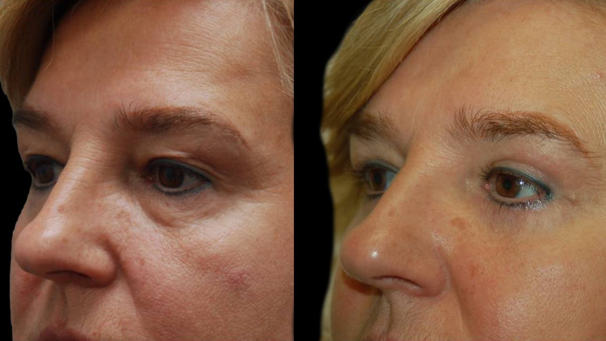 Upper & Lower Eyelid Surgery Before & After Gallery - Patient 246596 - Image 4