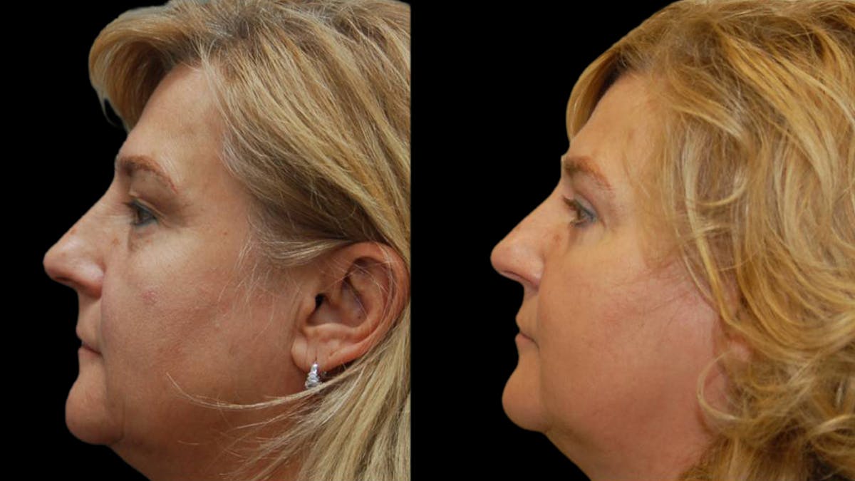 Upper & Lower Eyelid Surgery Before & After Gallery - Patient 246596 - Image 5