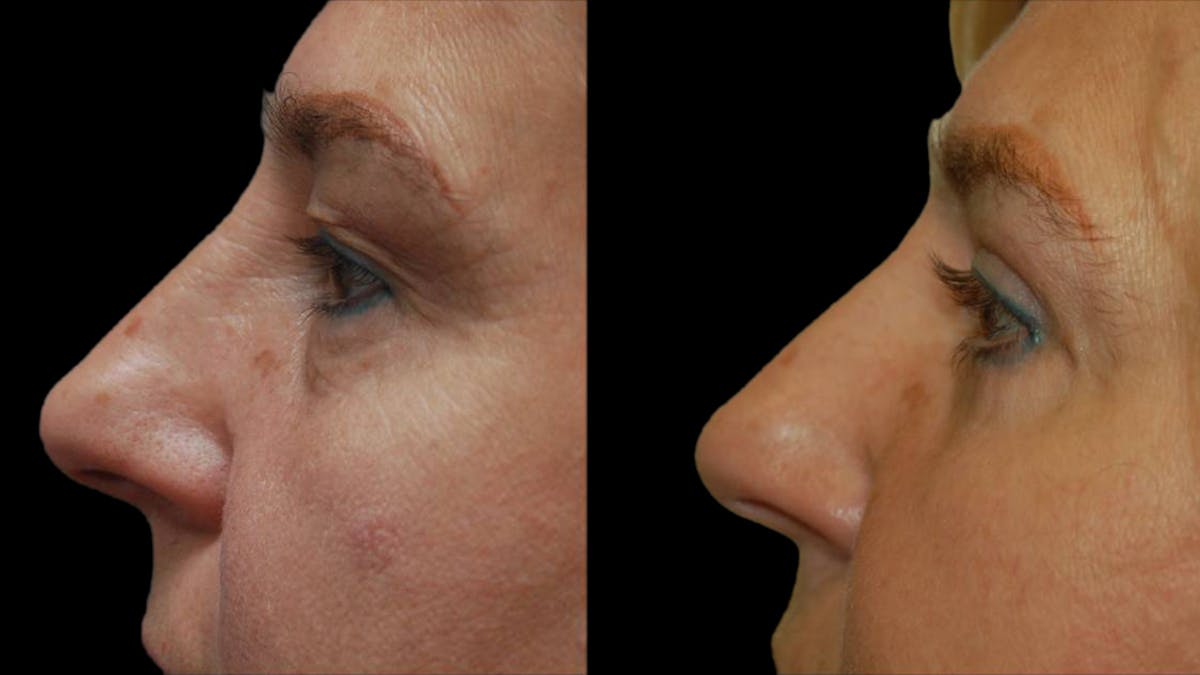 Upper & Lower Eyelid Surgery Before & After Gallery - Patient 246596 - Image 6